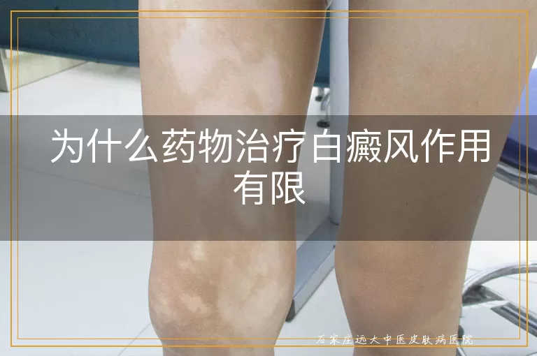 为什么药物治疗白癜风作用有限