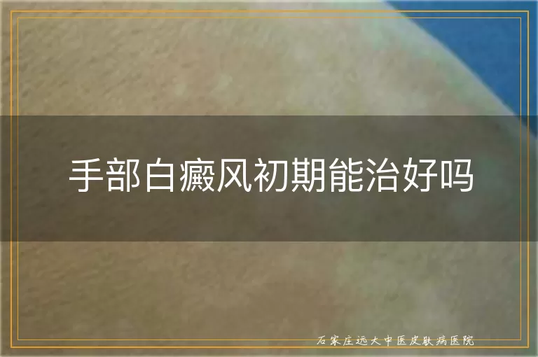 手部白癜风初期能治好吗