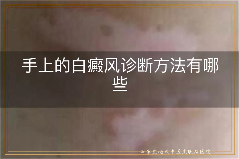 手上的白癜风诊断方法有哪些