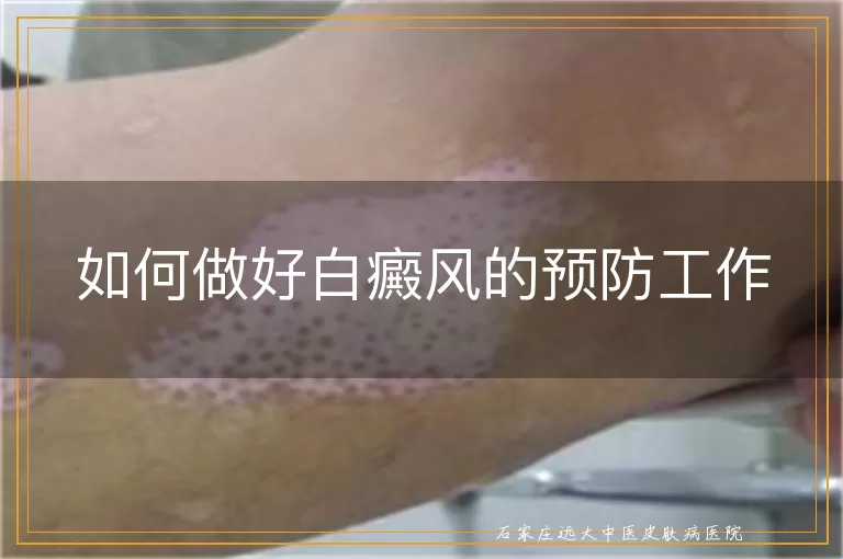 如何做好白癜风的预防工作