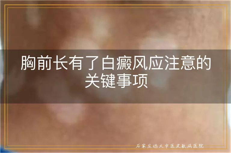胸前长有了白癜风应注意的关键事项