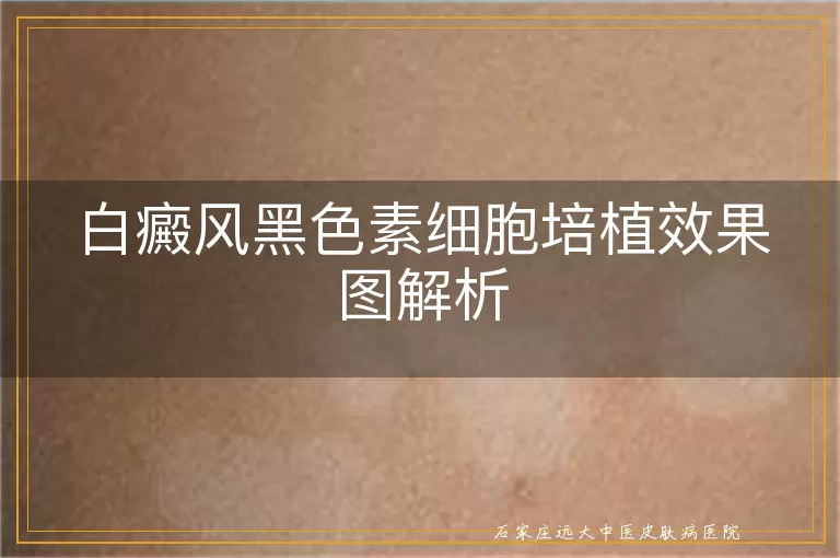 白癜风黑色素细胞培植效果图解析