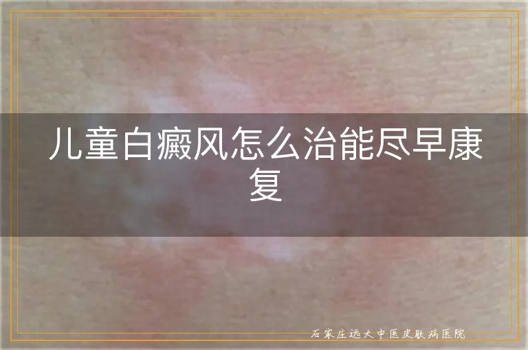 儿童白癜风怎么治能尽早康复