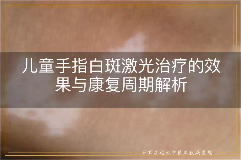 儿童手指白斑激光治疗的效果与康复周期解析