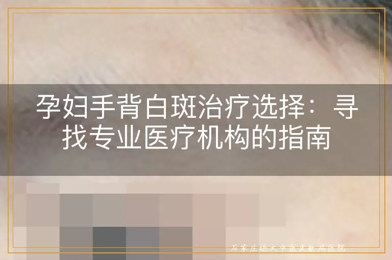 孕妇手背白斑治疗选择：寻找专业医疗机构的指南