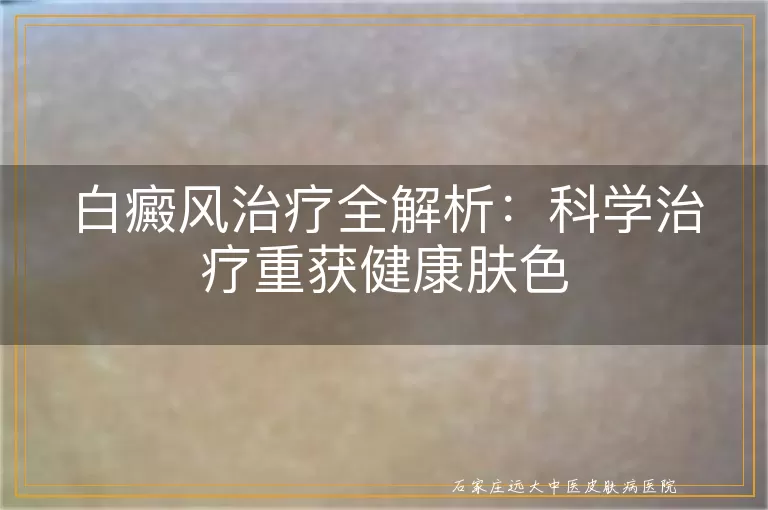 白癜风治疗全解析：科学治疗重获健康肤色