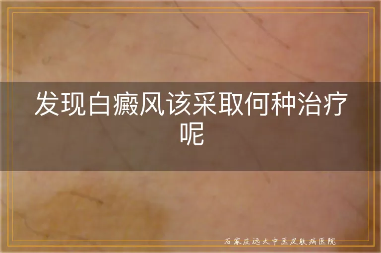 发现白癜风该采取何种治疗呢