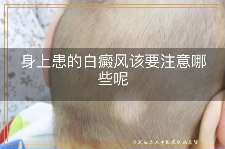 身上患的白癜风该要注意哪些呢
