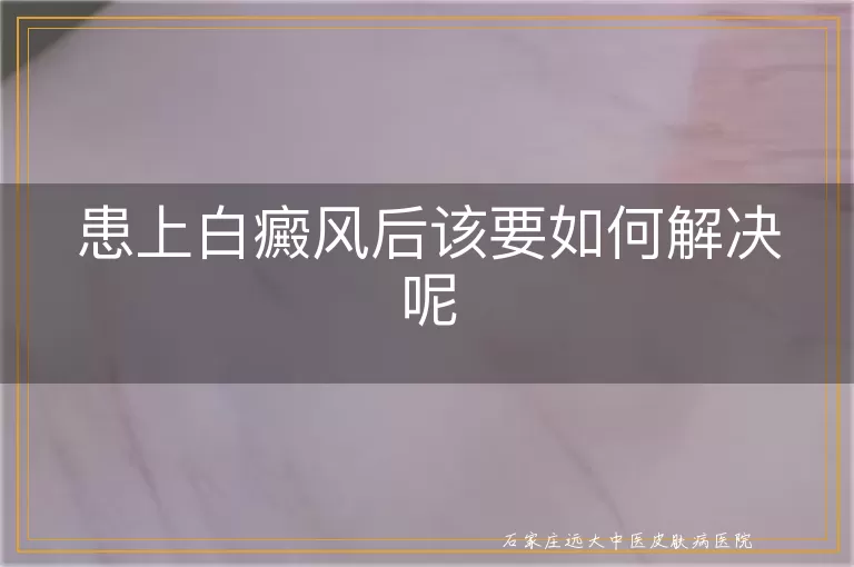 患上白癜风后该要如何解决呢