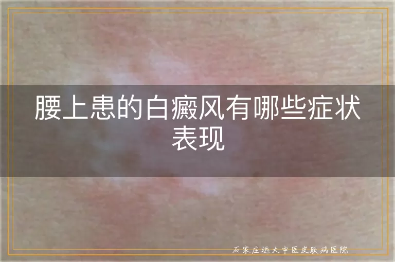 腰上患的白癜风有哪些症状表现