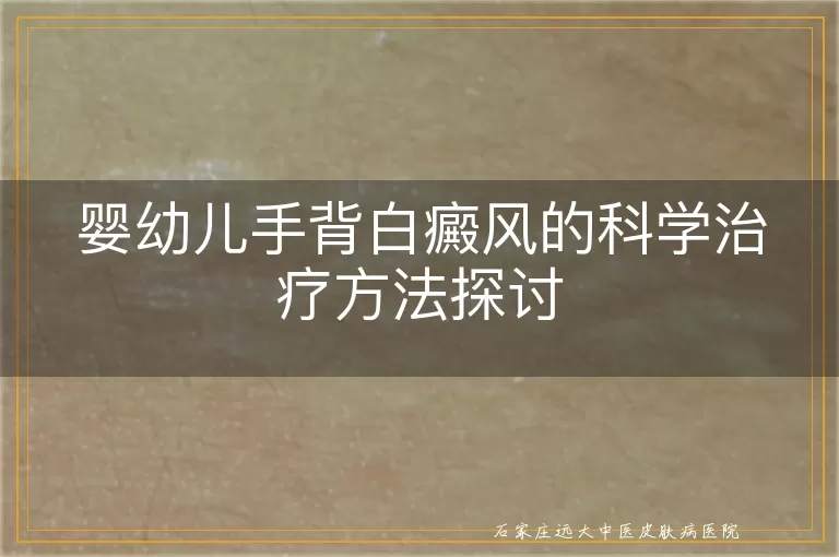 婴幼儿手背白癜风的科学治疗方法探讨
