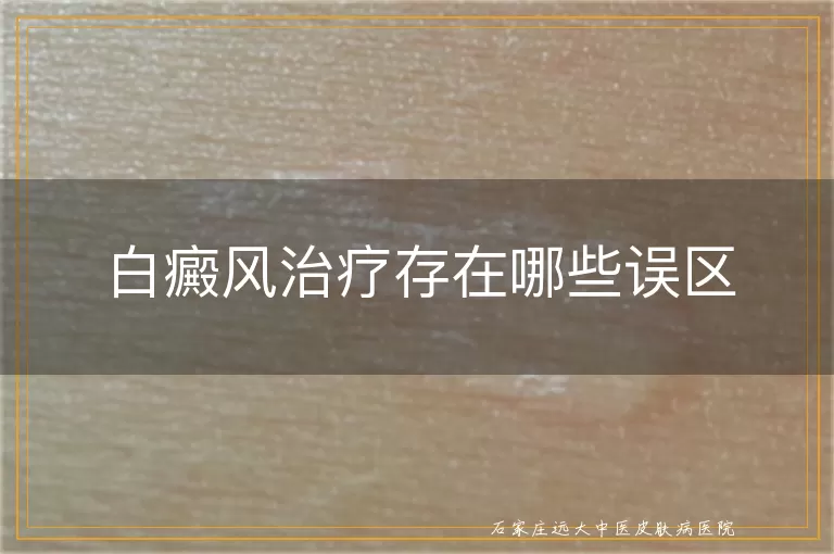 白癜风治疗存在哪些误区