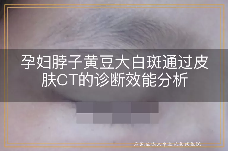 孕妇脖子黄豆大白斑通过皮肤CT的诊断效能分析