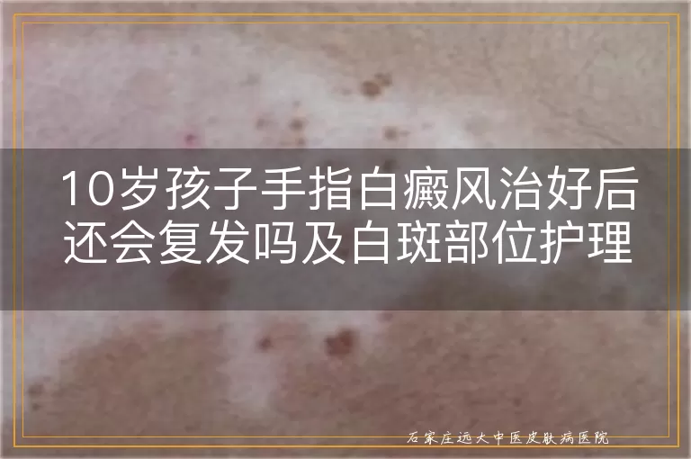 10岁孩子手指白癜风治好后还会复发吗及白斑部位护理指南