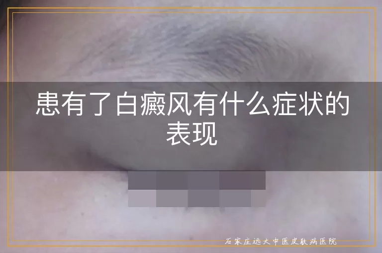 患有了白癜风有什么症状的表现