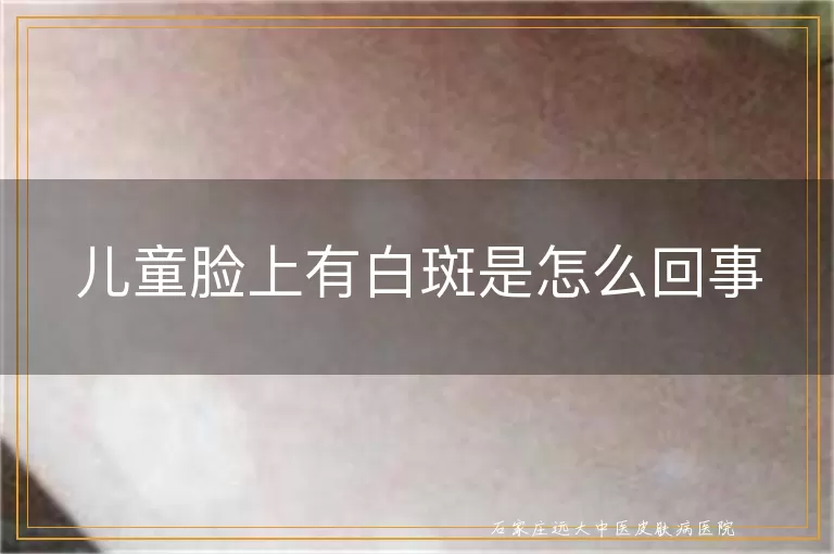 儿童脸上有白斑是怎么回事