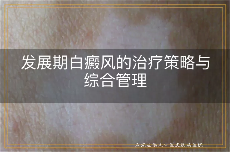 发展期白癜风的治疗策略与综合管理