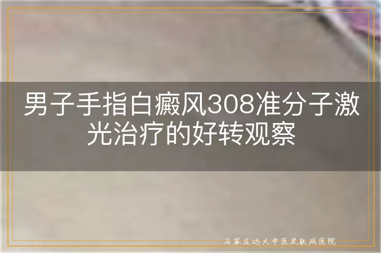 男子手指白癜风308准分子激光治疗的好转观察