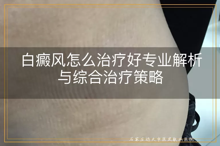 白癜风怎么治疗好专业解析与综合治疗策略