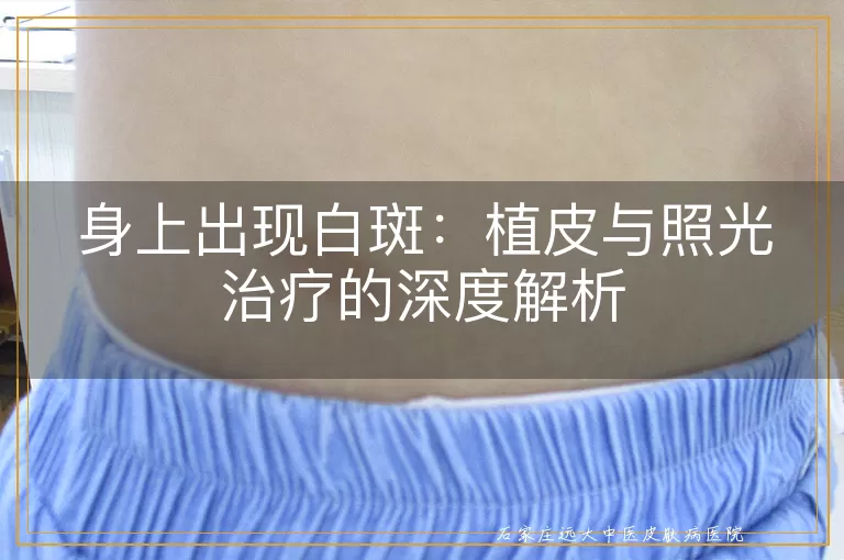 身上出现白斑：植皮与照光治疗的深度解析