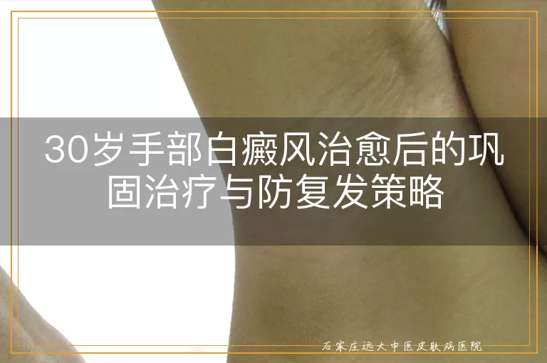 30岁手部白癜风治愈后的巩固治疗与防复发策略