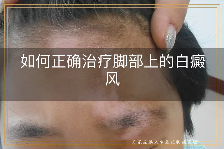 如何正确治疗脚部上的白癜风