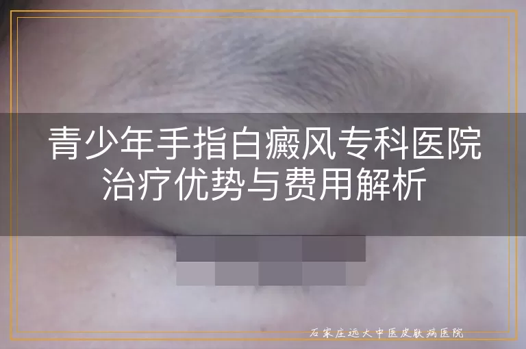 青少年手指白癜风专科医院治疗优势与费用解析