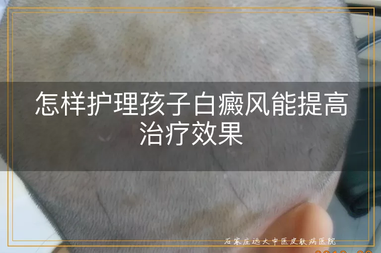 怎样护理孩子白癜风能提高治疗效果