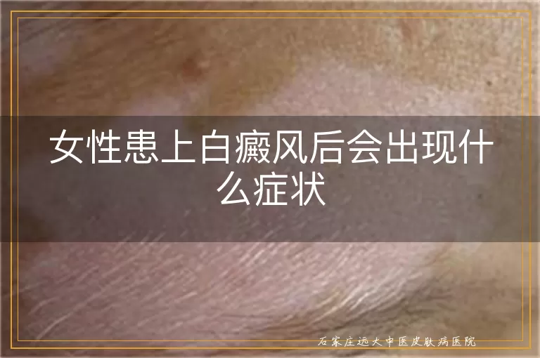 女性患上白癜风后会出现什么症状