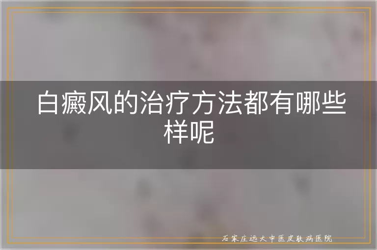白癜风的治疗方法都有哪些样呢