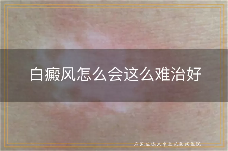 白癜风怎么会这么难治好