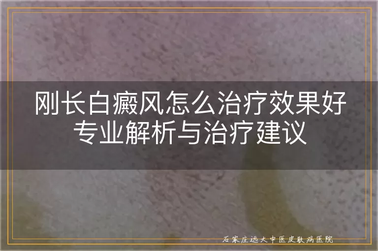 刚长白癜风怎么治疗效果好专业解析与治疗建议