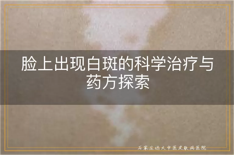 脸上出现白斑的科学治疗与药方探索