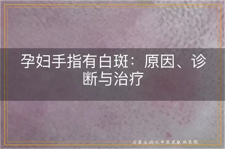 孕妇手指有白斑：原因、诊断与治疗