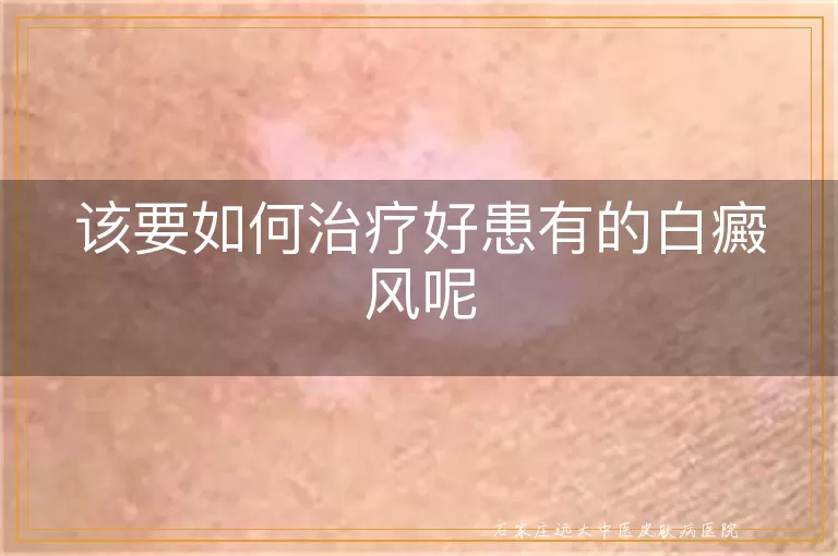 该要如何治疗好患有的白癜风呢