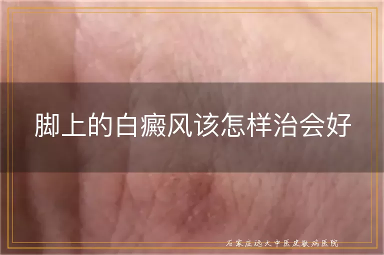 脚上的白癜风该怎样治会好