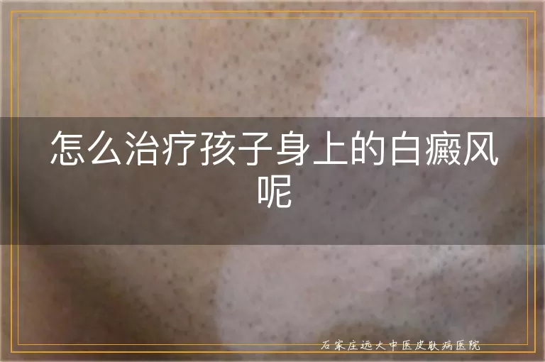 怎么治疗孩子身上的白癜风呢
