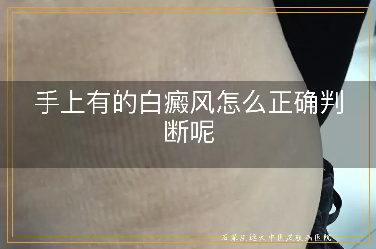 手上有的白癜风怎么正确判断呢
