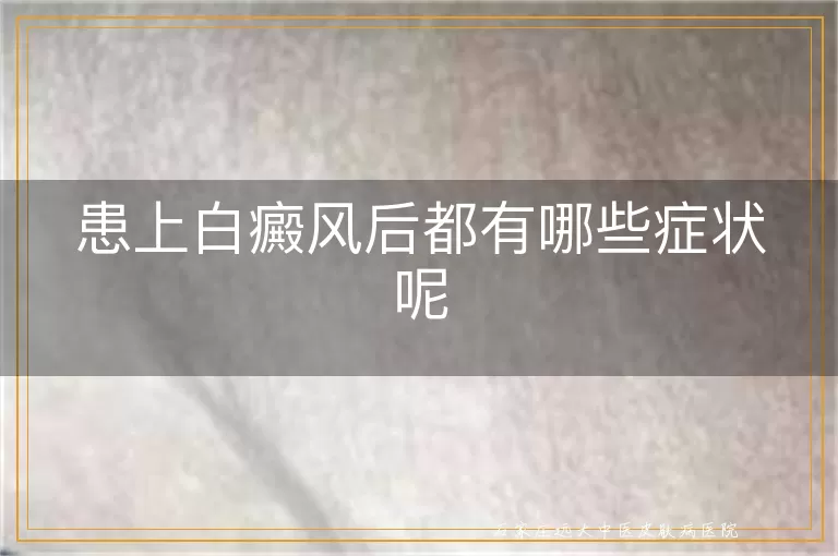 患上白癜风后都有哪些症状呢