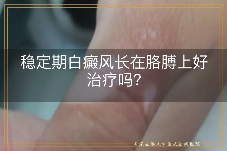 稳定期白癜风长在胳膊上好治疗吗？