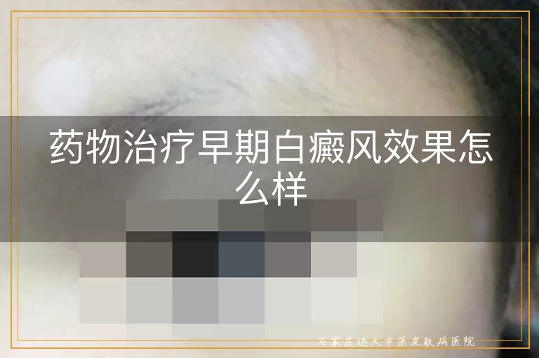 药物治疗早期白癜风效果怎么样