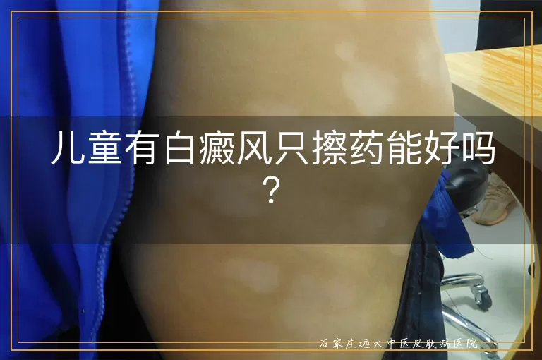儿童有白癜风只擦药能好吗？