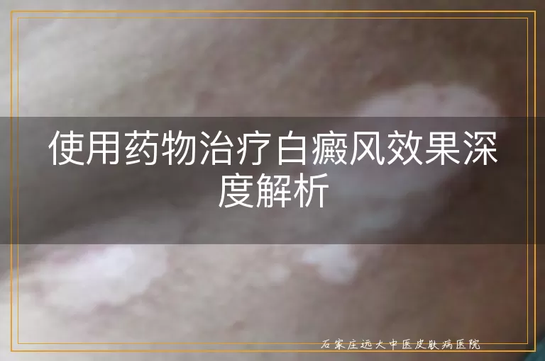 使用药物治疗白癜风效果深度解析