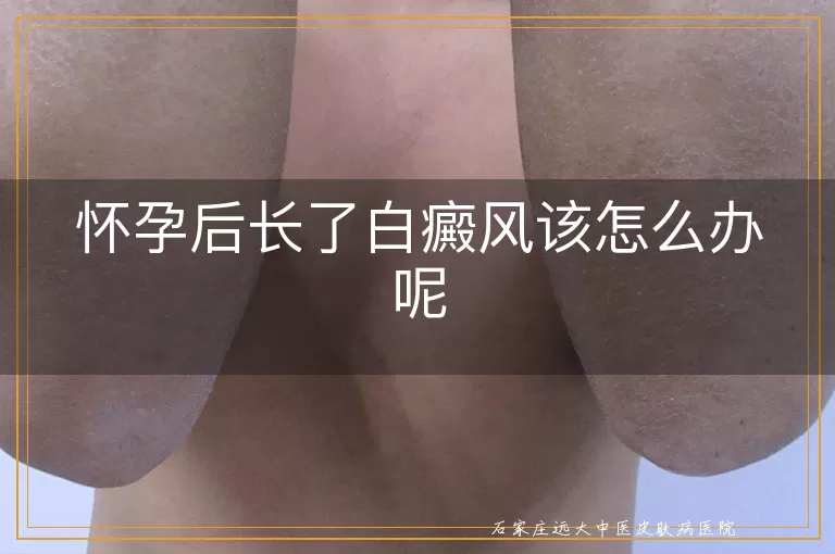 怀孕后长了白癜风该怎么办呢