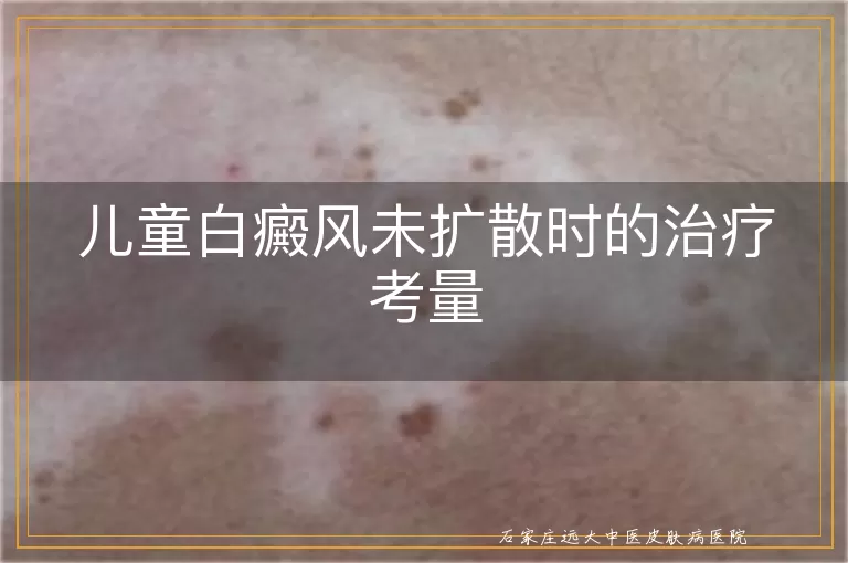 儿童白癜风未扩散时的治疗考量