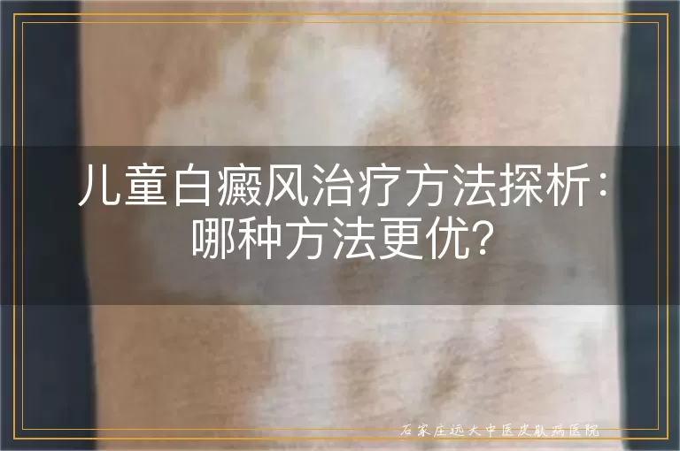儿童白癜风治疗方法探析：哪种方法更优？