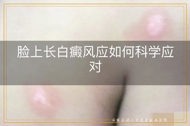 脸上长白癜风应如何科学应对