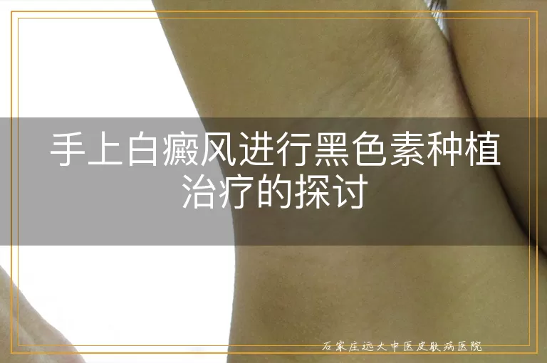手上白癜风进行黑色素种植治疗的探讨