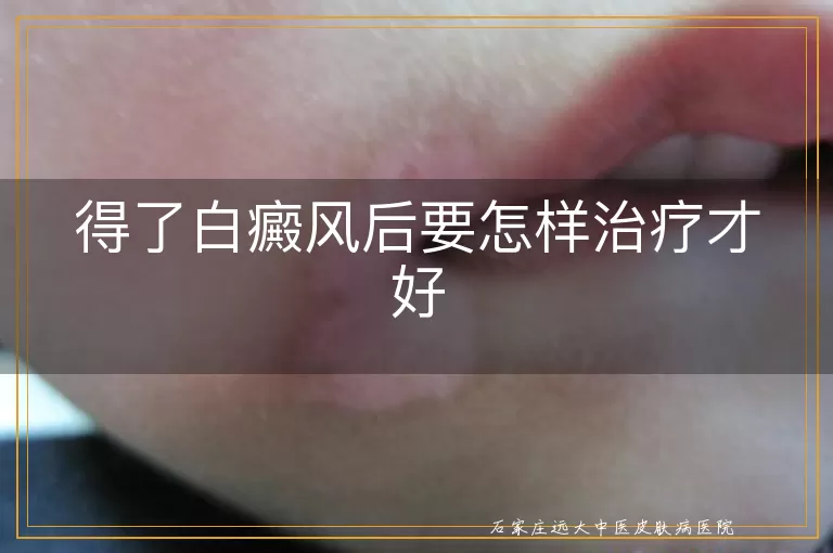得了白癜风后要怎样治疗才好