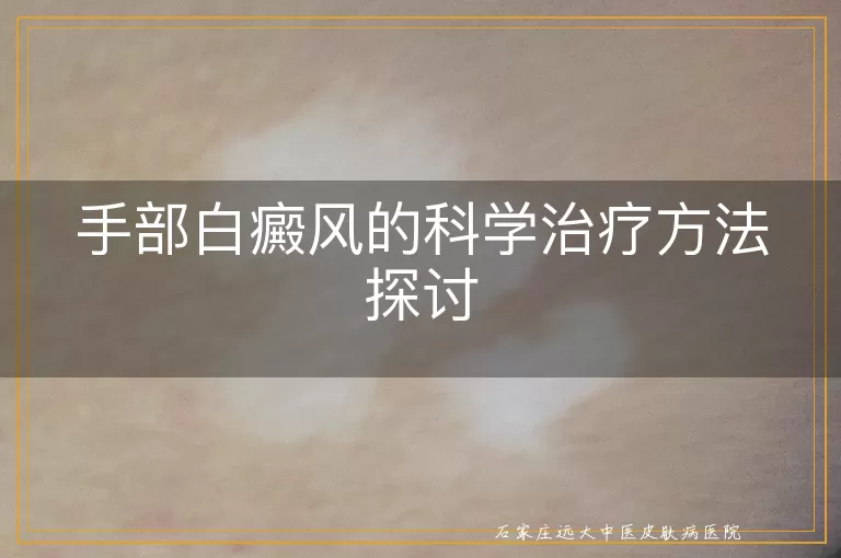 手部白癜风的科学治疗方法探讨